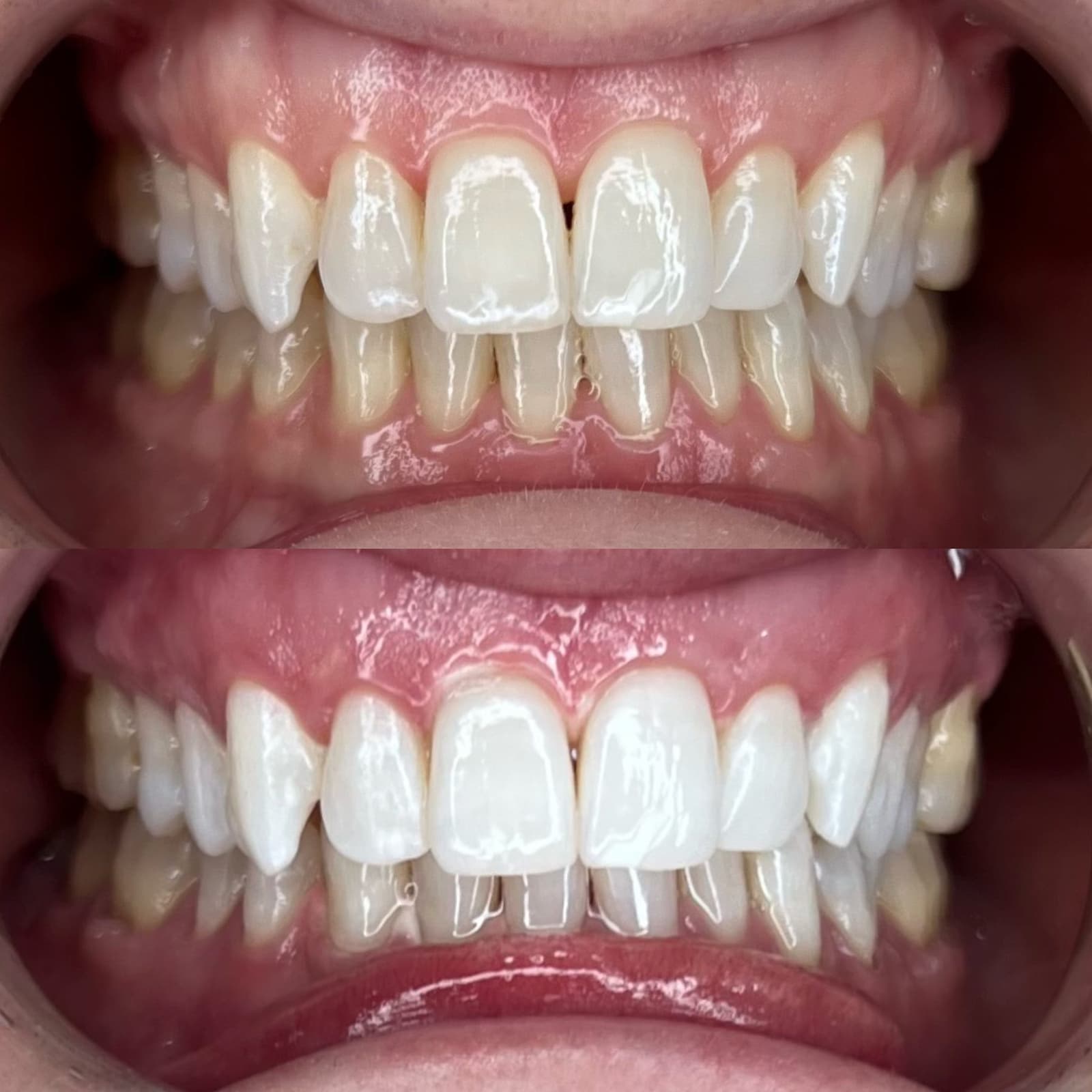 Signature Whiten — before