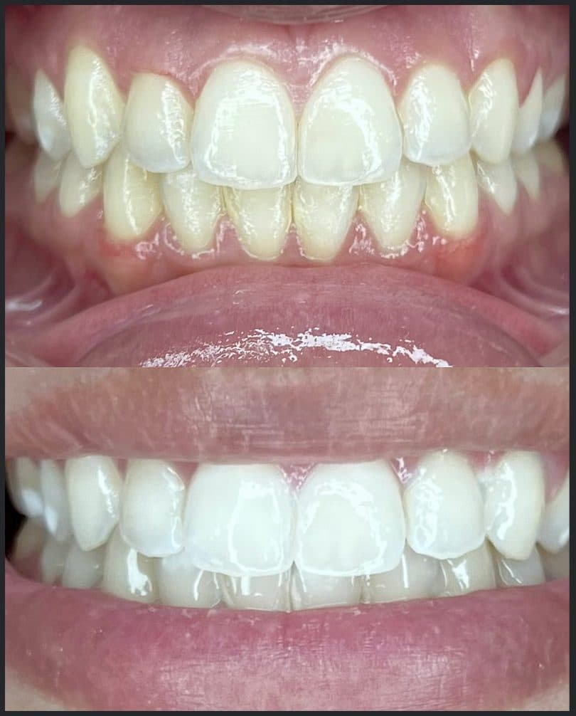 Deep Stain Lift — before