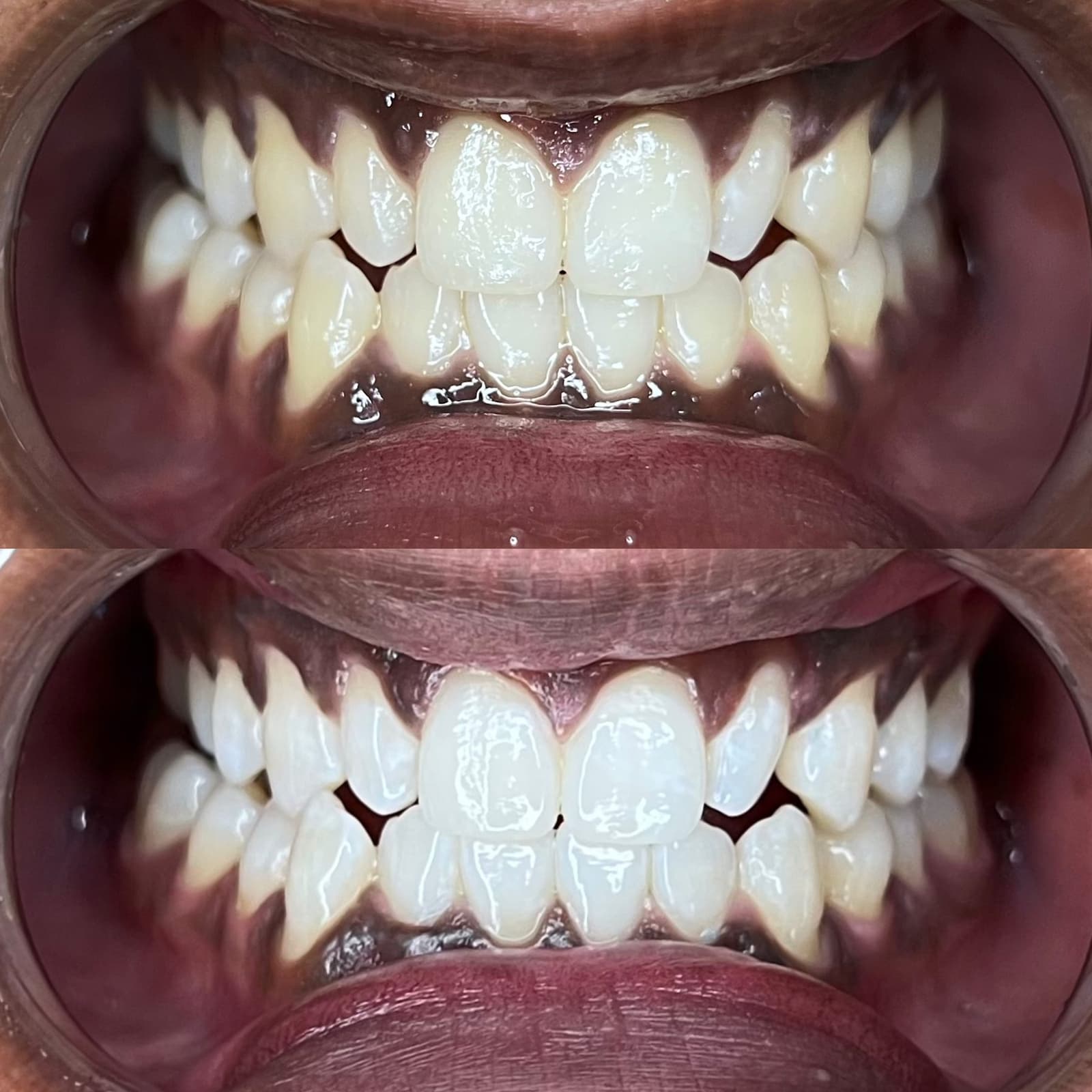 Shade-Matched Result