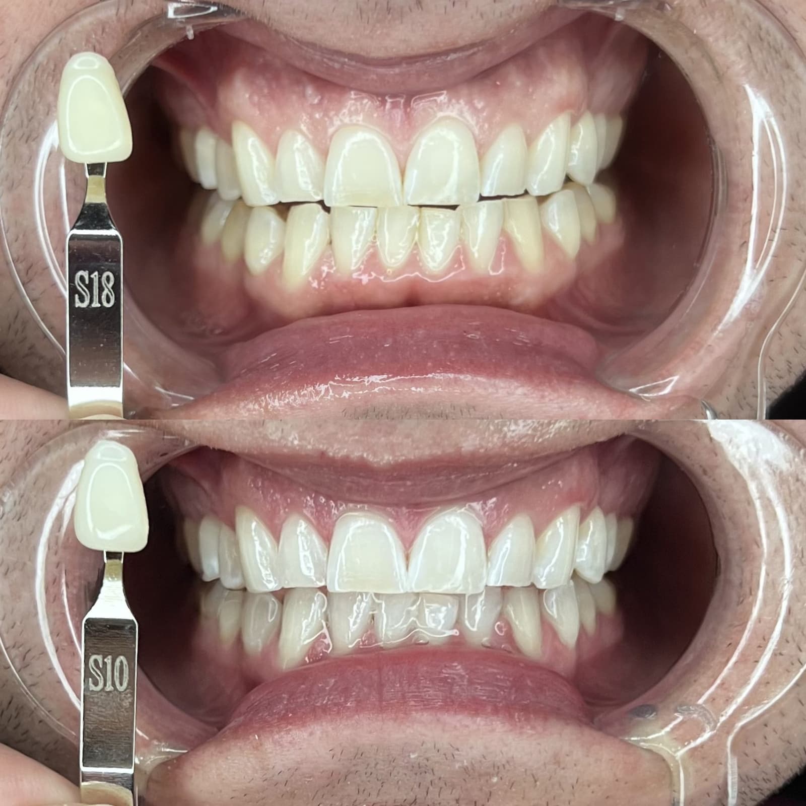Shade-Matched Result