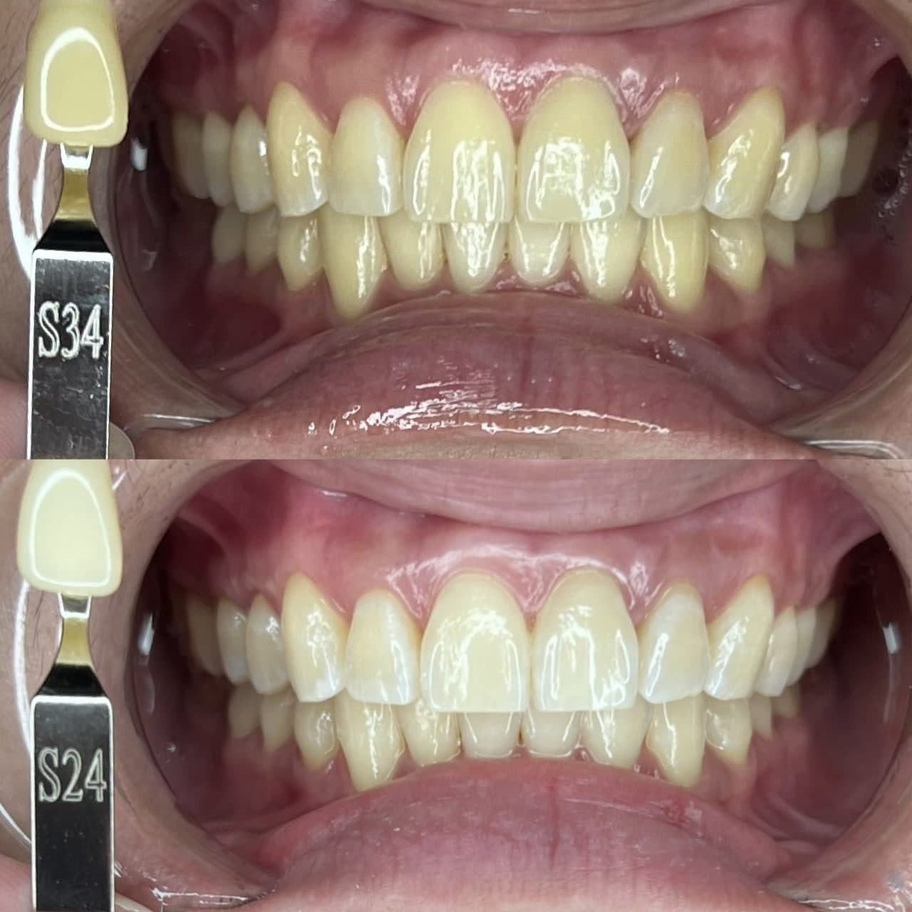 Shade-Matched Result